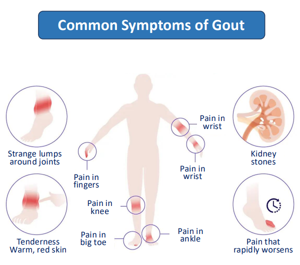 Common Symptoms of Gout