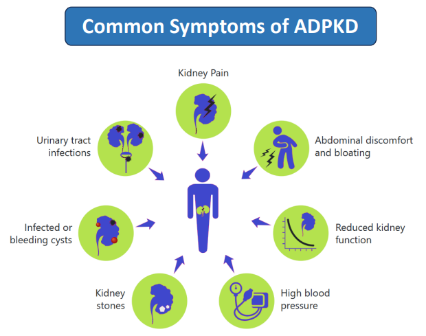 Common Symptoms of ADPKD