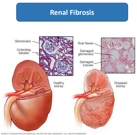 Renal Fibrosis - Healthy vs Diseased Kidney